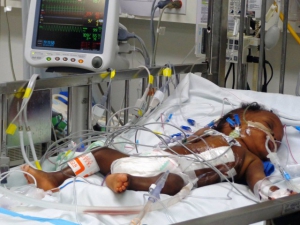 Marian, one of the conjoined twins, recuperates after surgery.