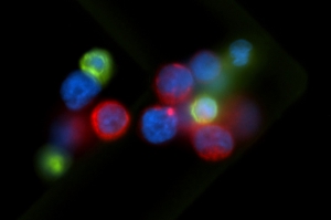 A cluster of circulating tumor cells (red) and white blood cells (green).