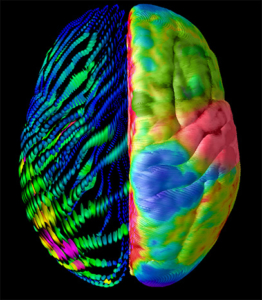 Some 5 percent of all epilepsy cases (and 20 percent of symptomatic epilepsy cases) arise from traumatic brain injury, such as blows to the temporal lobe (shown in red). (Image/Arthur W. Toga, USC Laboratory of Neuro Imaging, USC Stevens Neuroimaging and Informatics Institute)