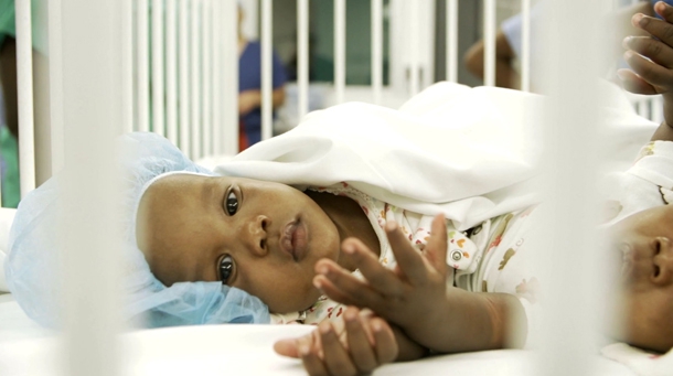 A team of physicians and nurses from Children's Hospital Los Angeles (CHLA) and Keck Medicine of USC led an international collaboration to separate a pair of six-month-old conjoined Haitian twins. 