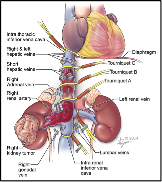 Inferior vena cava control for which individualized surgical planning is necessary, including locations of many blood vessels to be clamped and indicators of the extent of Levels I, II and III thrombi, and the relative sizes of the obstructions. 