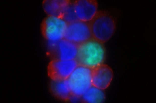 A CTC cluster stained for keratin (red) and proliferation marker (green).