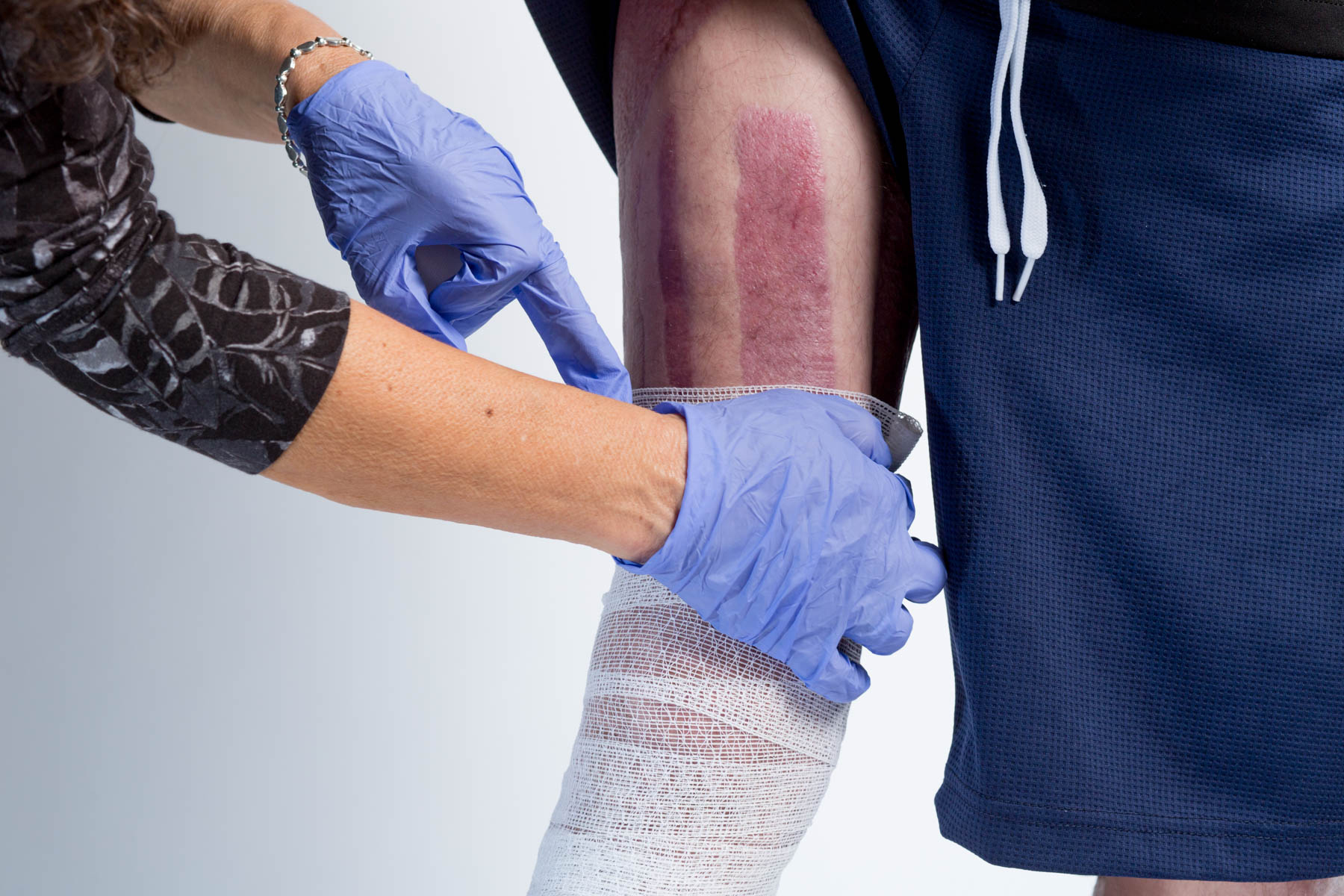 To stay ahead of the flesh-eating bacteria, a team of six wound care physical therapists dressed patient Alfred Lopez’s wounds every day, which sometimes took up to two hours to complete.