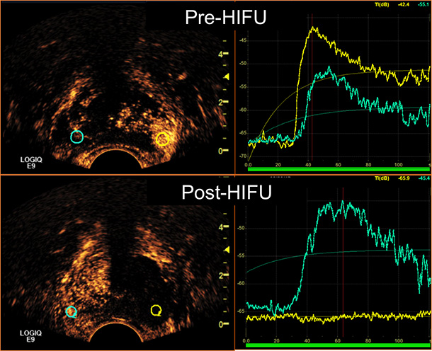 Pre- and Post-HIFU and Contrast-Enhanced Ultrasound (CEUS): Pre-HIFU microbubble-ultrasound contrast agent is injected to identify the cancer lesion (yellow circle that corresponds to yellow curve showing high contrast uptake). Post lesion-targeted HIFU ablation, CEUS confirms ablated targeted cancer area (yellow circle that corresponds to yellow curve showing no contrast uptake).