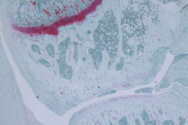 Osteoarthritis leads to the progressive loss of joint cartilage, shown in red. 