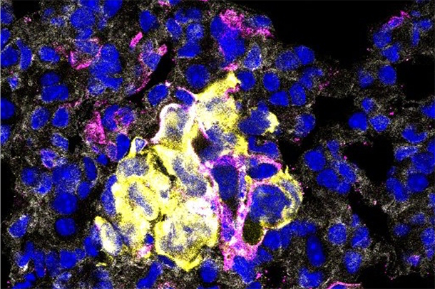 Metastatic breast cancer cells (yellow) interacting with macrophages (magenta)