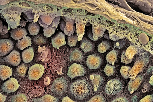 Cancer in the prostate gland, seen here in yellow, is common for older men. A team including USC scientists found telltale genetic traits to predict men who are most at risk.