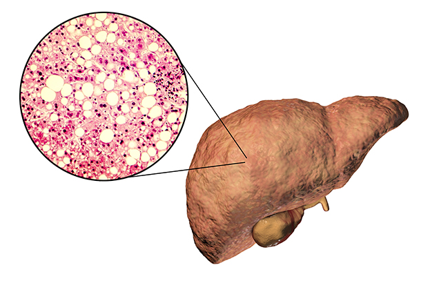 Fatty liver, liver steatosis, 3D illustration and pgotomicrograph of fat accumlated inside liver cells as occurs in both alcoholic and non-alcoholic fatty liver disease.