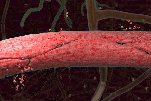 This image depicts a blood vessel in the brain that's become leaky, or permeable.