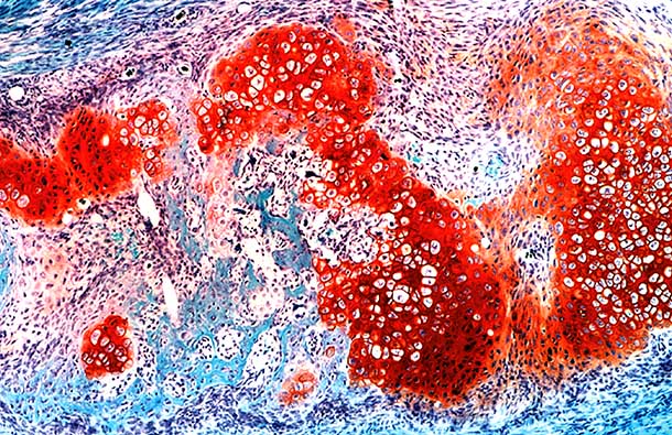 The image depicts the bridging callus that forms during large-scale rib bone repair. Cells surrounded by the orange stain (Safranin O) are special hybrid cartilage/bone cells that mediate repair. They are stimulated to participate in repair by the action of special “messenger” cells.