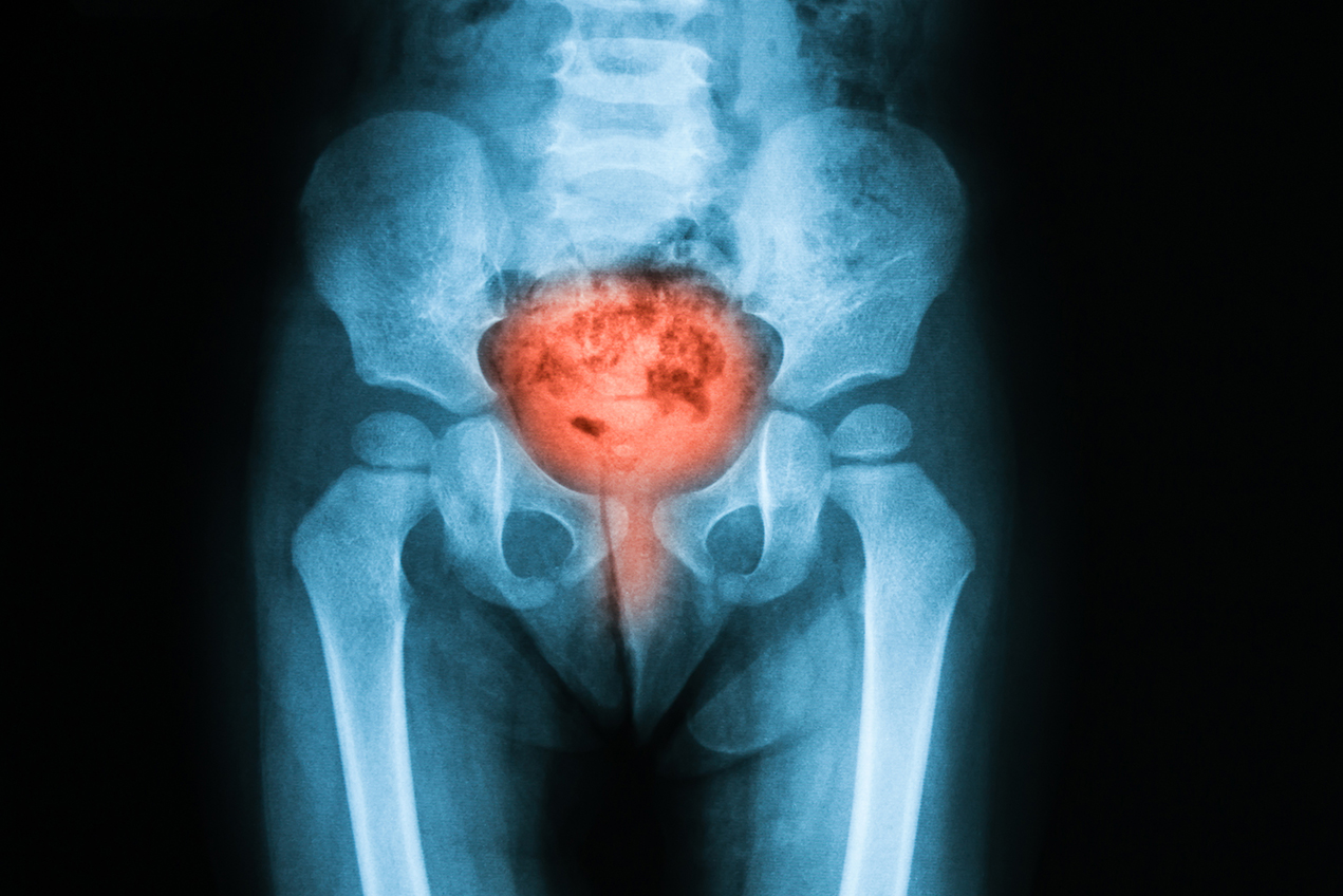 More than 10 million Americans are affected by urologic chronic pelvic pain syndrome.