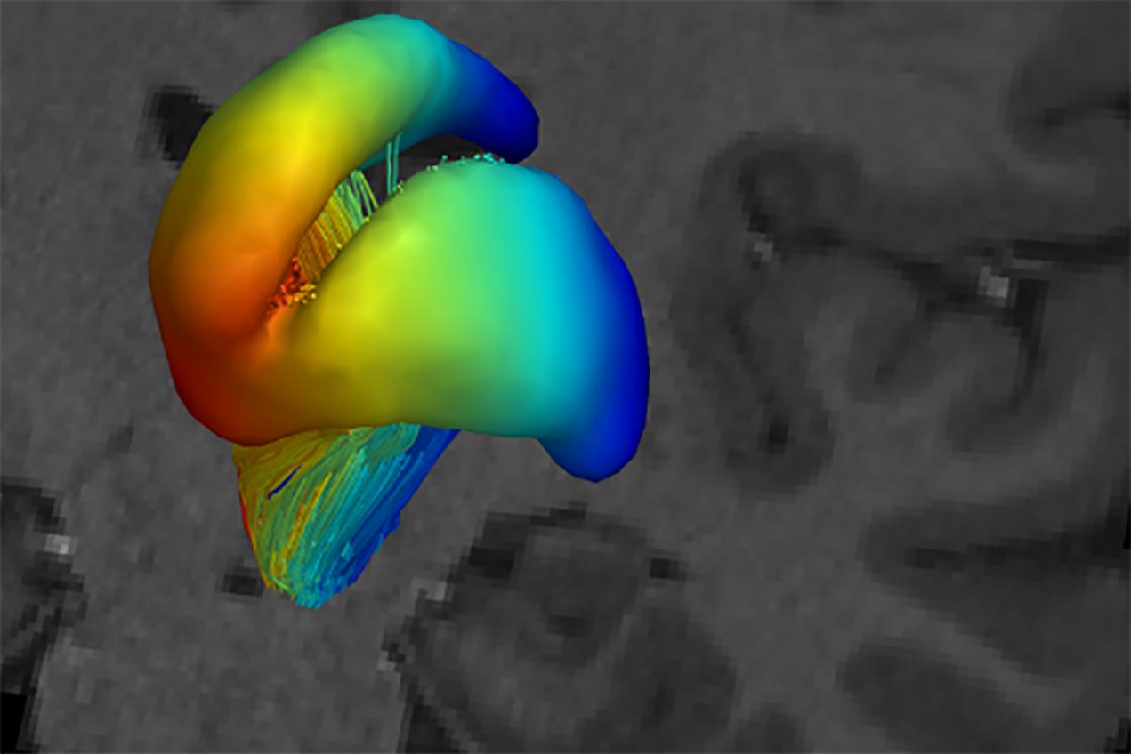With connectome imaging data and cutting-edge modeling tools developed through Yonggang Shi’s research, a critical pathway of the reward network from the striatum to the dopaminergic midbrain areas is reconstructed with high anatomical fidelity.