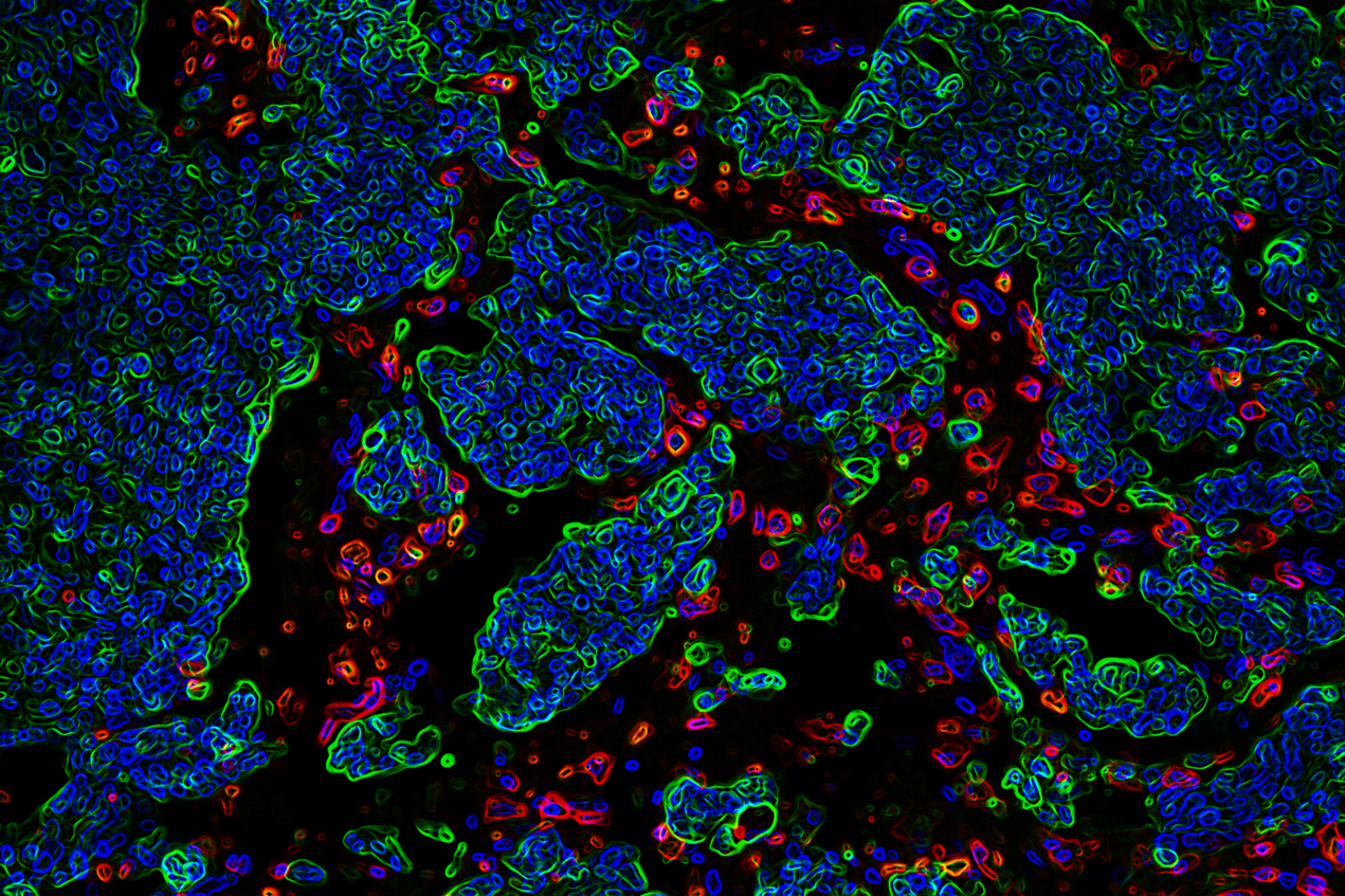 Development of brain metastasis is a complex process in which metastatic cells (green) overcome the protective effect of immune cells (red).