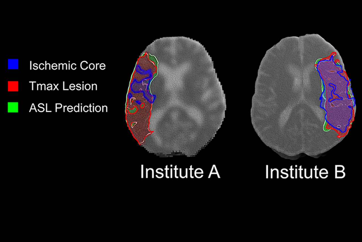 Researchers at the USC Mark and Mary Stevens Neuroimaging and Informatics Institute are working on safer ways to scan the brains of stroke patients in assessing damage.