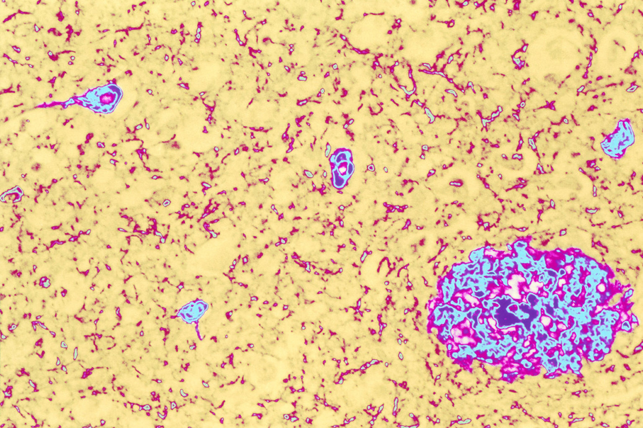 Colored light micrograph of brain tissue from an Alzheimer's disease patient. Both of the classic pathological features of this disease are seen here. At lower right is a large plaque (pink/blue) containing the abnormal protein amyloid. Also seen are several neurofibrillary tangles (smaller blue areas), thickened parts of the cytoplasm of nerve cells. Both of these abnormalities disrupt the normal working of the brain. 