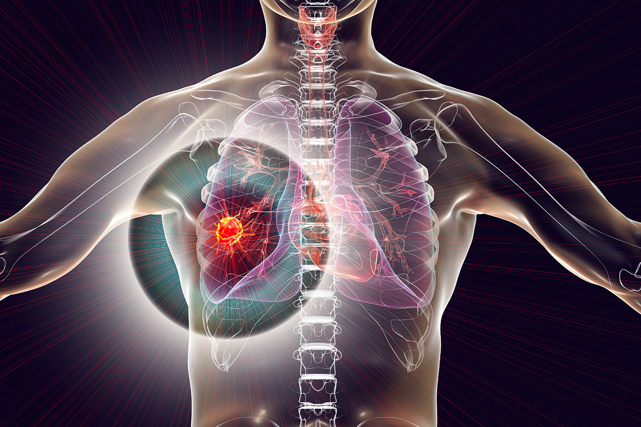 Keck Medicine of USC study reveals that socioeconomic status disparities cause patients to miss out on treatment that improves five-year lung cancer survival rate.