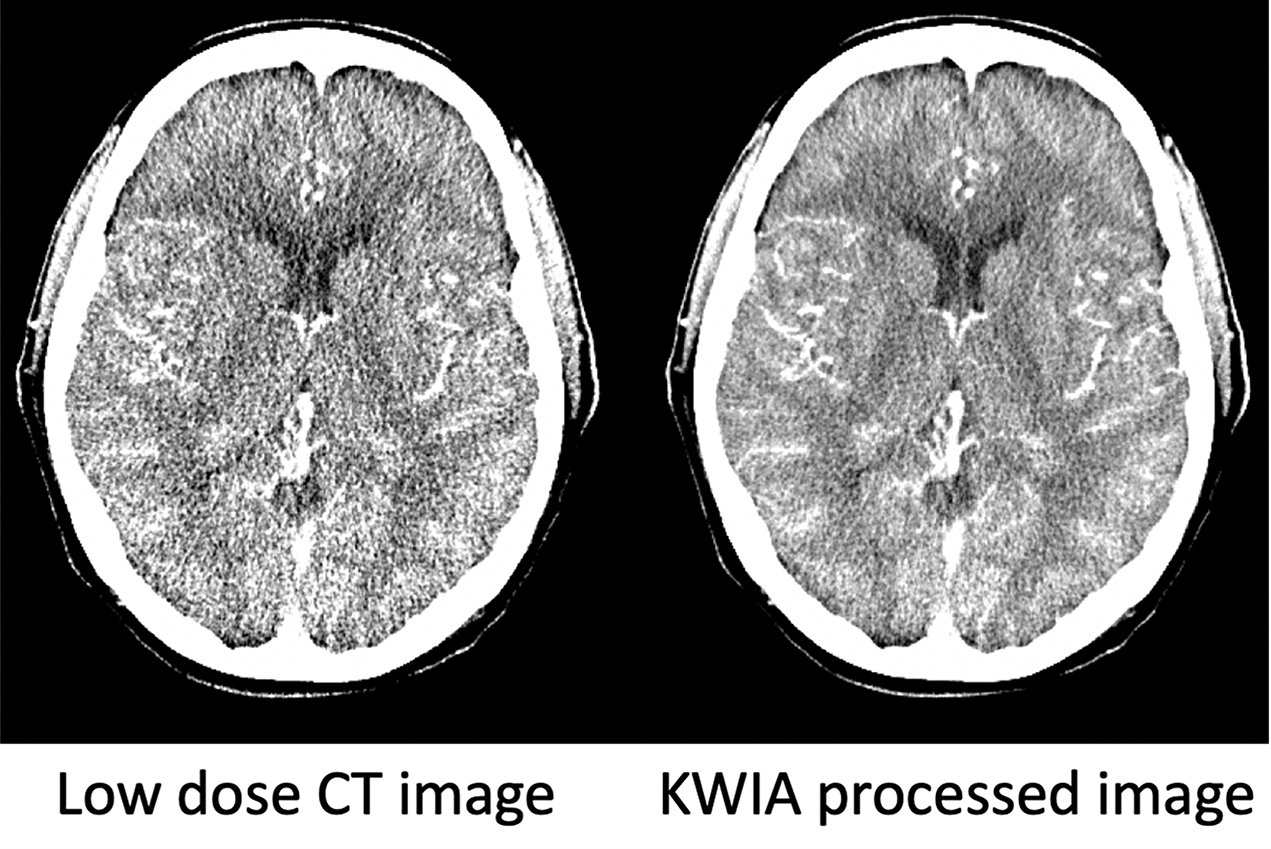 Compared to existing low-dose CT technologies, the research team’s new technique, known as K-space Weighted Image Average (KWIA), has the advantages of fast computation speed and excellent retention of the texture and resolution of CT images.
