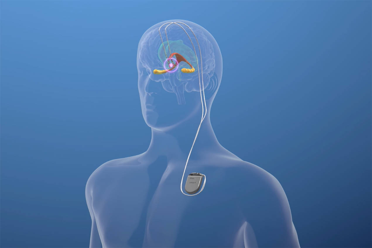 A transparent human figure and deep brain stimulation tools are seen on a blue background