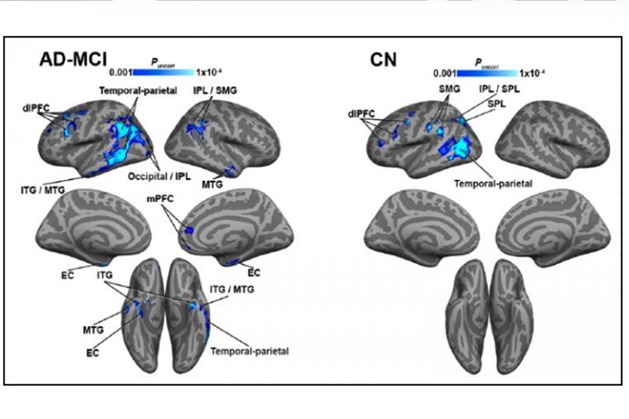 Decreased blood flow is linked to more severe tau pathology in regions of the brain affected by Alzheimer’s disease. On the left, Alzheimer’s disease and mild cognitive impairment; on the right, cognitively normal participants.