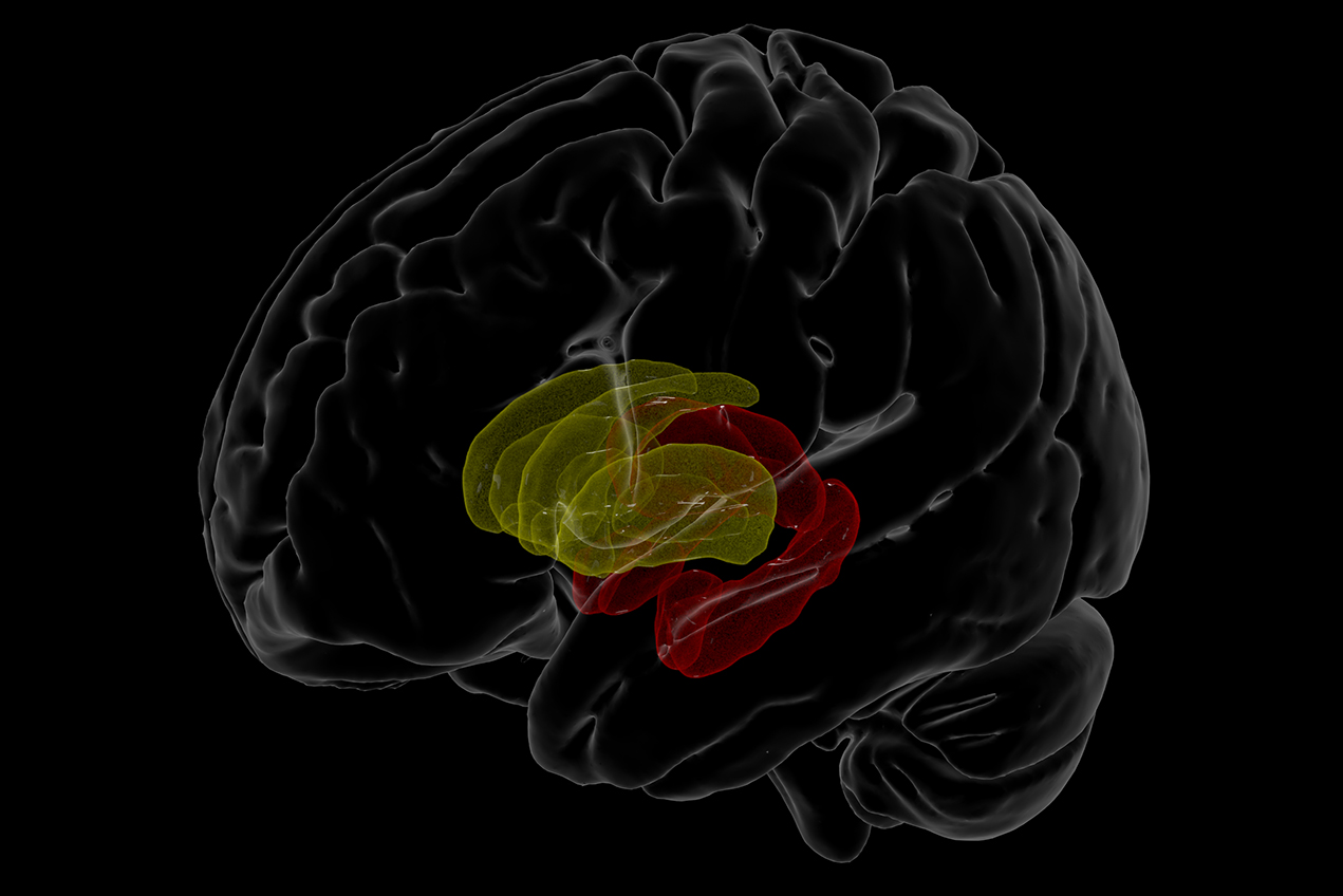 The shift of HIV-infection from a fatal to chronic condition in the era of more widely available treatment appears to be accompanied by a shift in the profile of HIV-related brain abnormalities beyond the basal ganglia (yellow), frequently implicated in earlier studies, to limbic structures (red).
