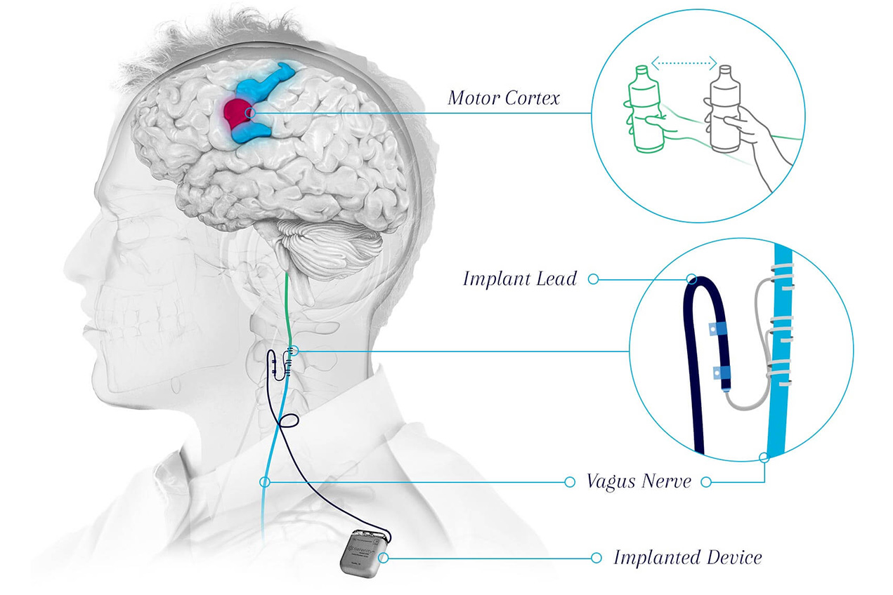 An illustration demonstrates an implanted device that stimulates the vagus nerve