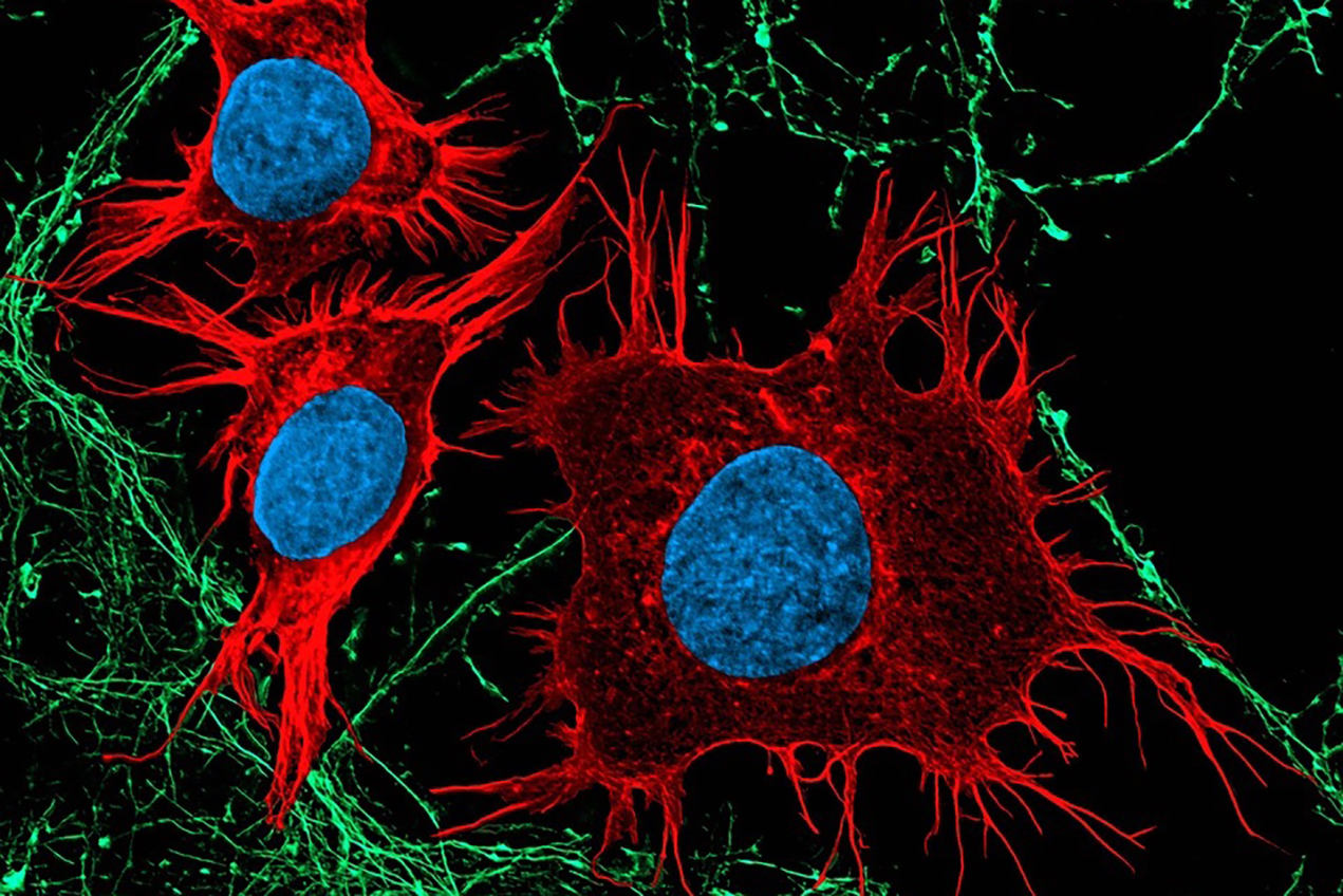 The image depicts neurons (green) in co-culture with medulloblastoma cells (red). Phenotypically, two contrasting cell types – the former normal and quiescent, while the latter cancerous and proliferating. Martirosian et al., through the perspective of cancer neuroscience, now provide evidence that rare cells in this pediatric brain tumor masquerade like quiescent neurons and exploit a neurotransmitter metabolic pathway to survive in the cerebrospinal fluid and promote leptomeningeal metastases.