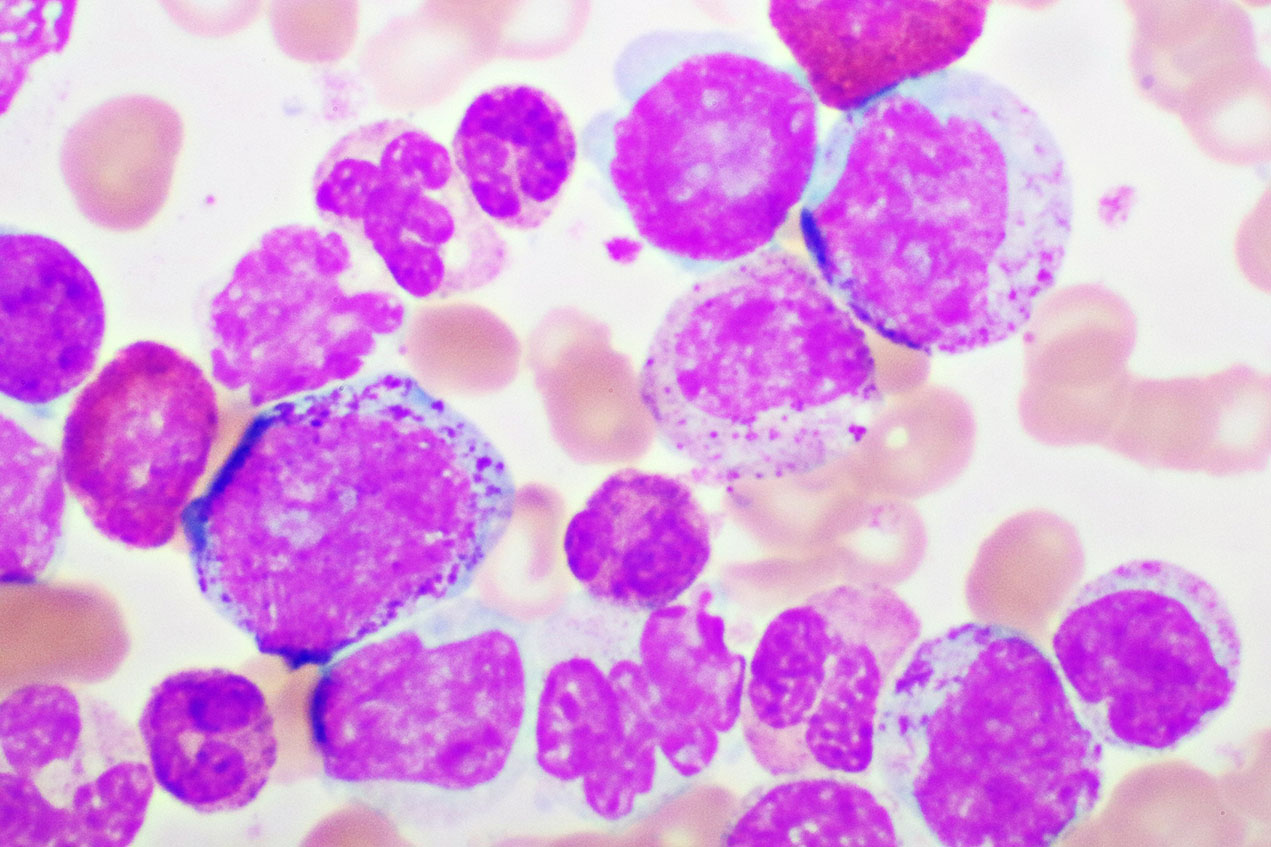 According the research, children genetically predisposed to overproduce lymphocytes in relation to other white blood cells are at higher risk for pediatric ALL.