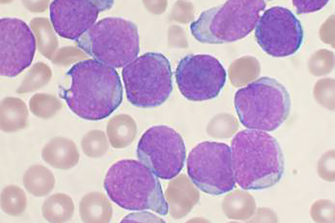 Leukemia cells