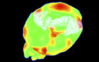 A PET image shows a colorfully glowing brain.