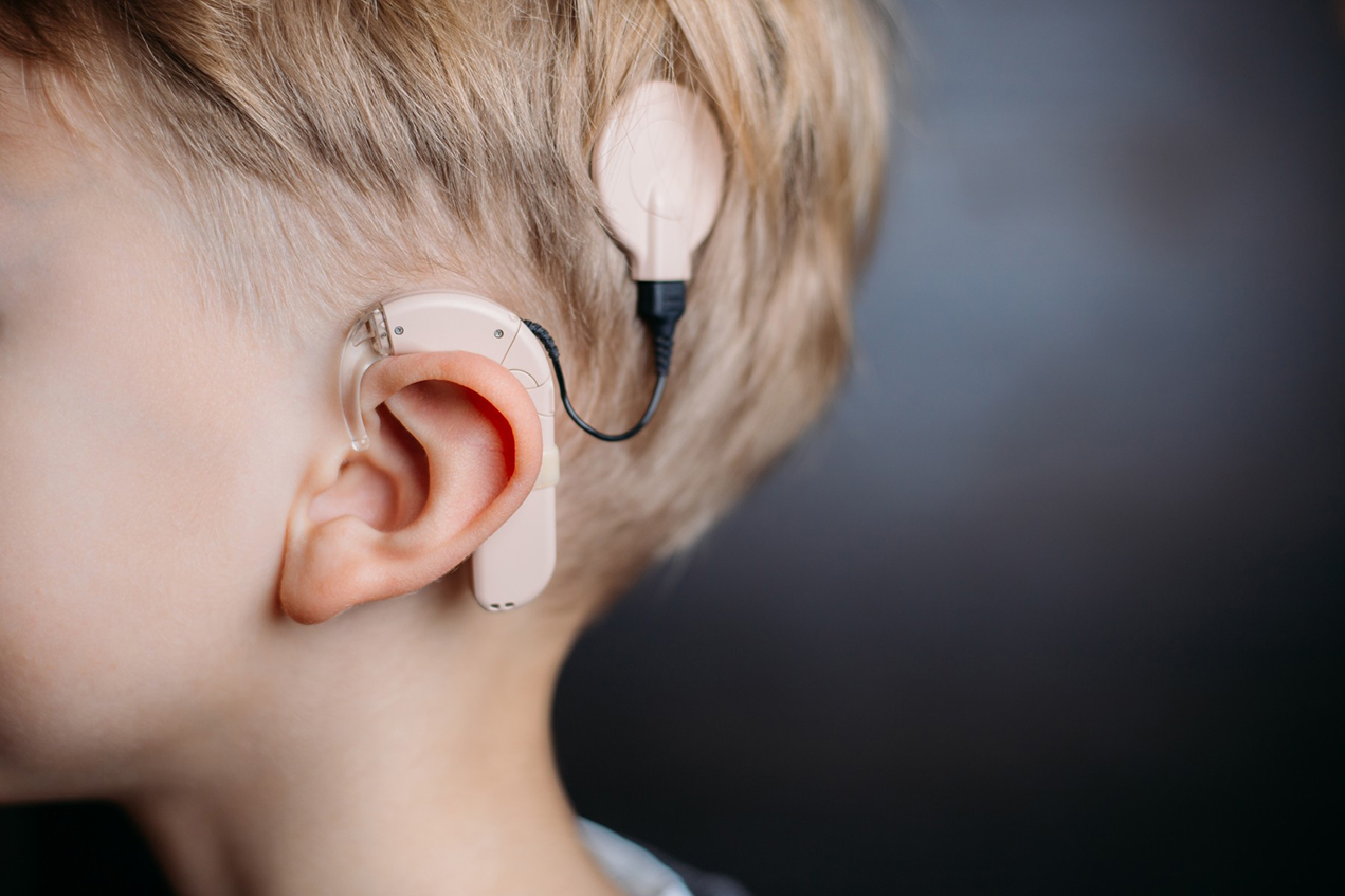 A Keck Medicine of USC study has demonstrated the need for early cochlear implant use for deaf children, regardless of developmental impairments.