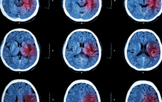 A medical film sheet shows multiple images of a brain with a red spot on the right half.