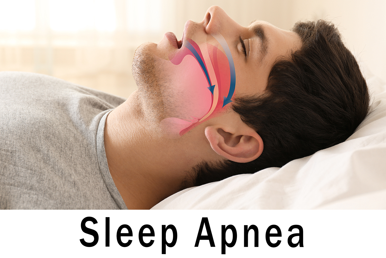 While sleep apnea is commonly caused by anatomy, there can be neurological reasons for the disorder as well.