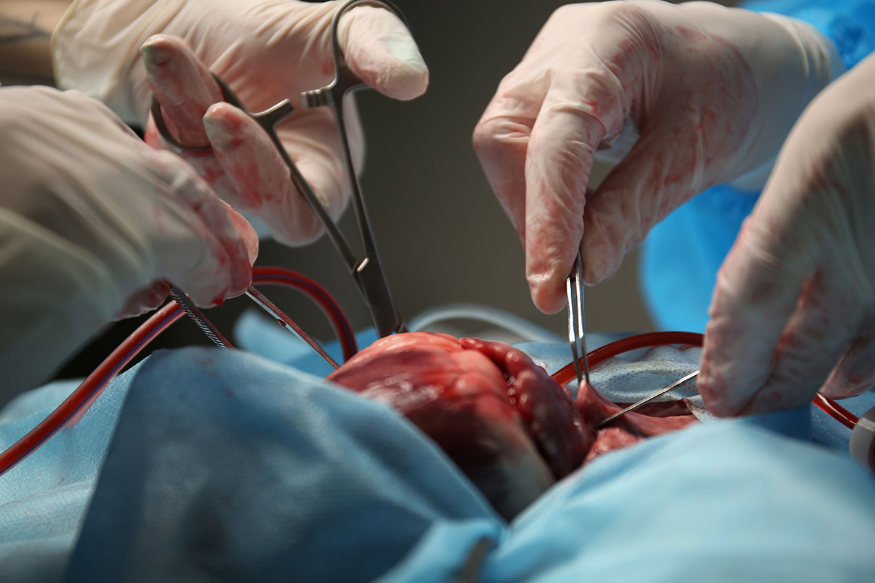 For heart transplants performed since Jan. 1, 2019, 98.2% of patients at Keck Hospital have survived with functioning transplants one year after their surgeries, compared to a national average of 90.7%.