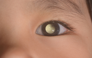 A closeup of a baby's eye with leukocoria, or a white pupil.