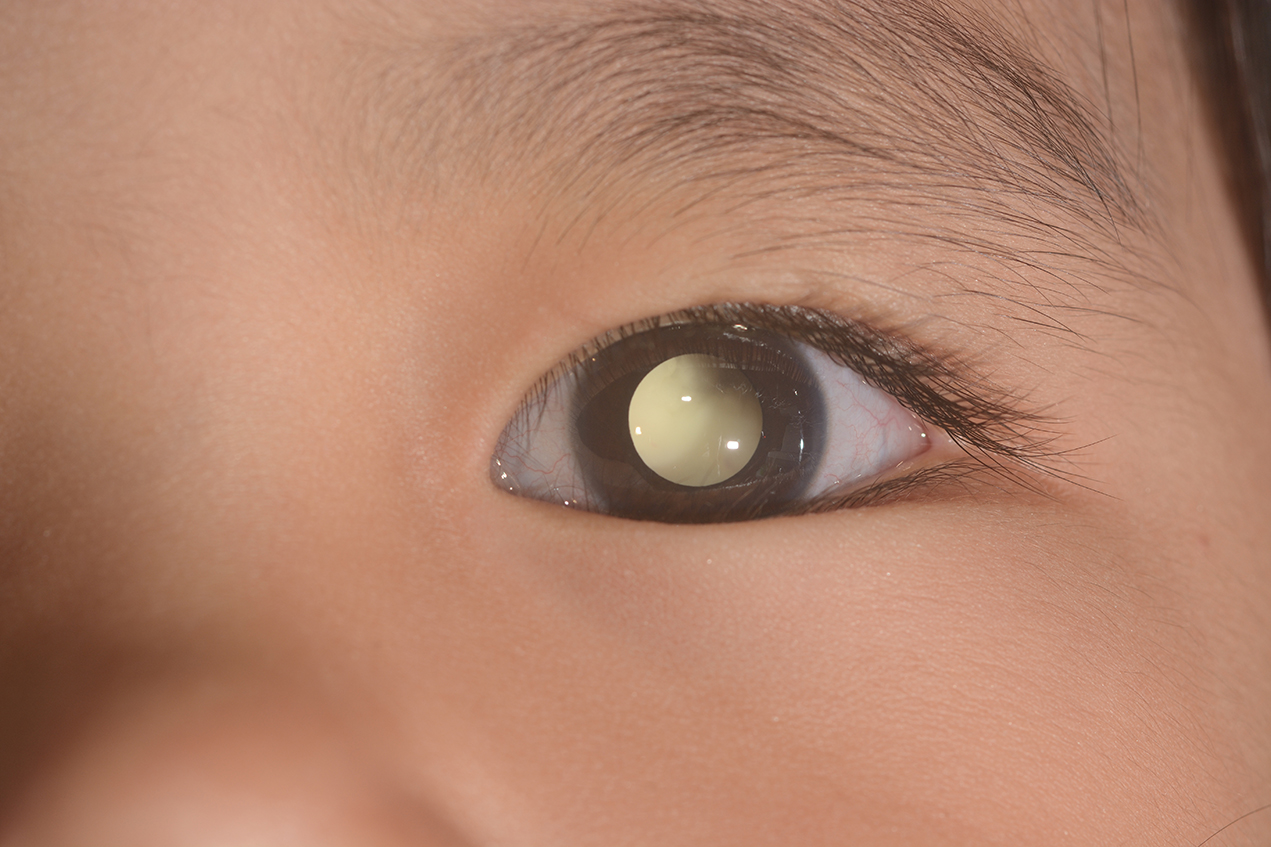 A common symptom of retinoblastoma is leukocoria, pictured here.