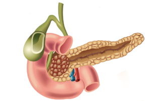 An medical illustration depicts a large tumor inside a pancreas