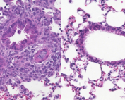 In two photos, the one on the left shows asthmatic lung inflammation in purple, with greatly reduced inflammation on the right.