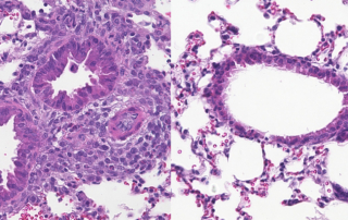 In two photos, the one on the left shows asthmatic lung inflammation in purple, with greatly reduced inflammation on the right.