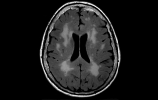 An example of white matter hyperintensities on a FLAIR MRI scan in an older adult.