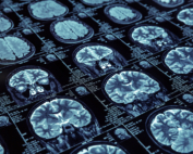 Multiple MRIs provide data for a presymptomatic Alzheimer's disease study
