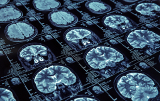 Multiple MRIs provide data for a presymptomatic Alzheimer's disease study