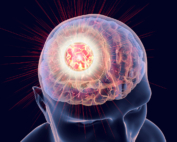 An illustration depicts how electric fields may be an effective treatment option for glioblastoma