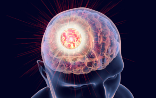 An illustration depicts how electric fields may be an effective treatment option for glioblastoma
